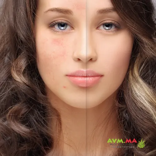 كريم ألوي بروبوليس: حل طبيعي للعناية بالبشرة الدهنية